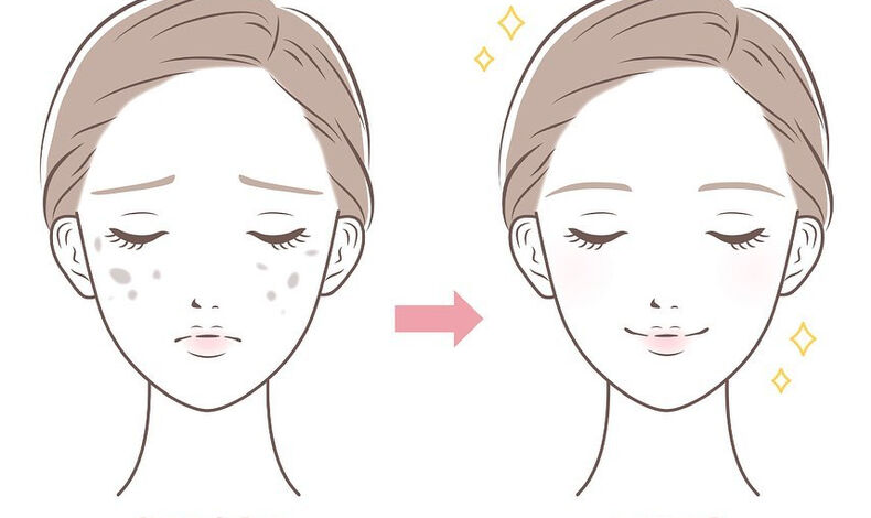 画像1844：トラネキサム酸注射💉・Tranexamic acid inj